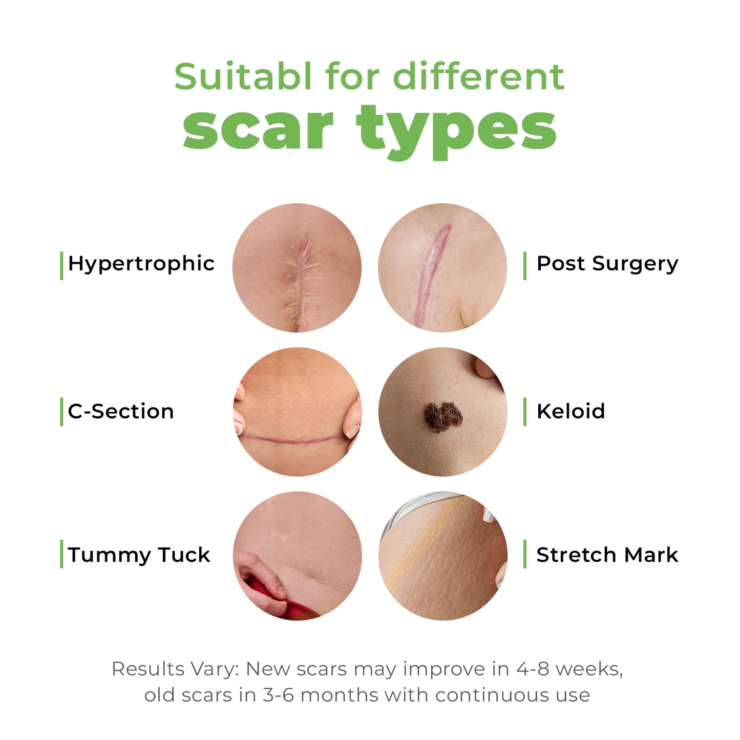 Trusavor Silicone Scar Sheets – Reusable, Breathable & Pain-Relieving Tape for Scar Treatment